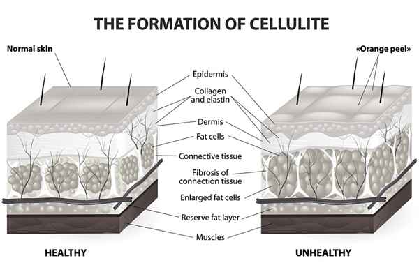 cellulite