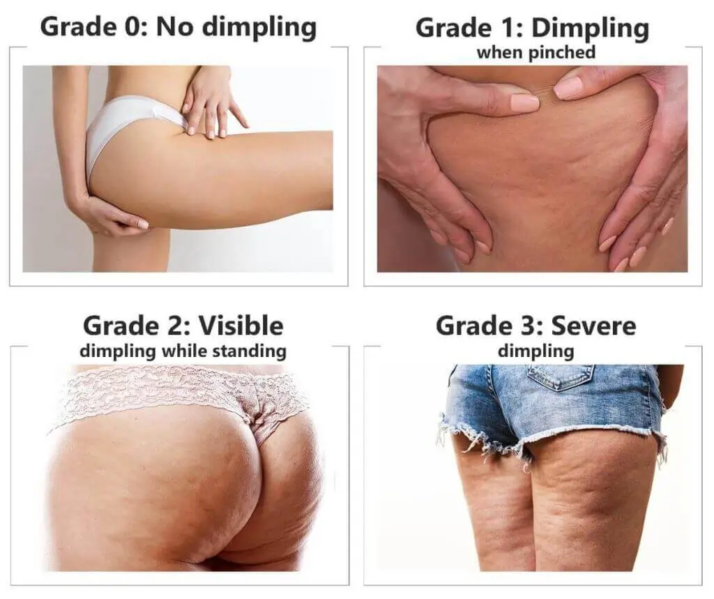 Representation of the stages of cellulite development Swindon